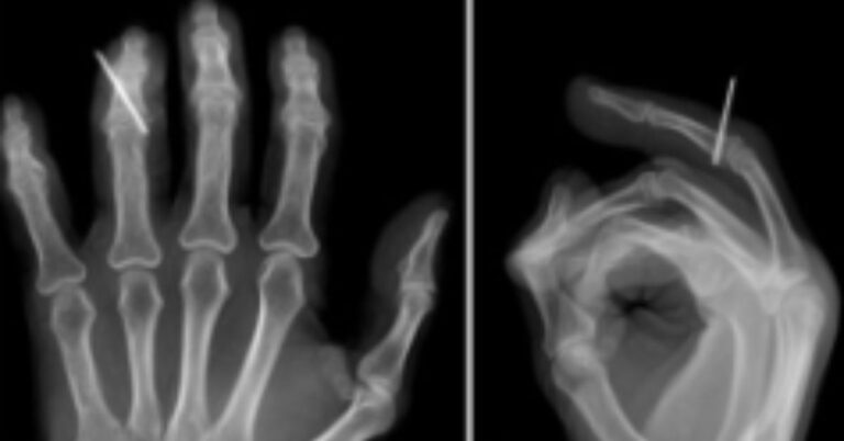 New Surgical Technique Simplifies Complex Phalangeal Fractures Using K-Wire Fixation