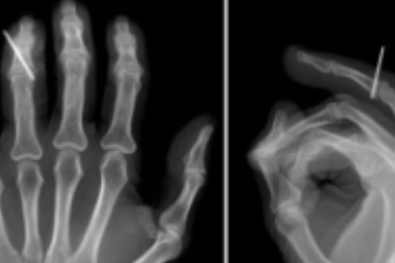 New Surgical Technique Simplifies Complex Phalangeal Fractures Using K-Wire Fixation