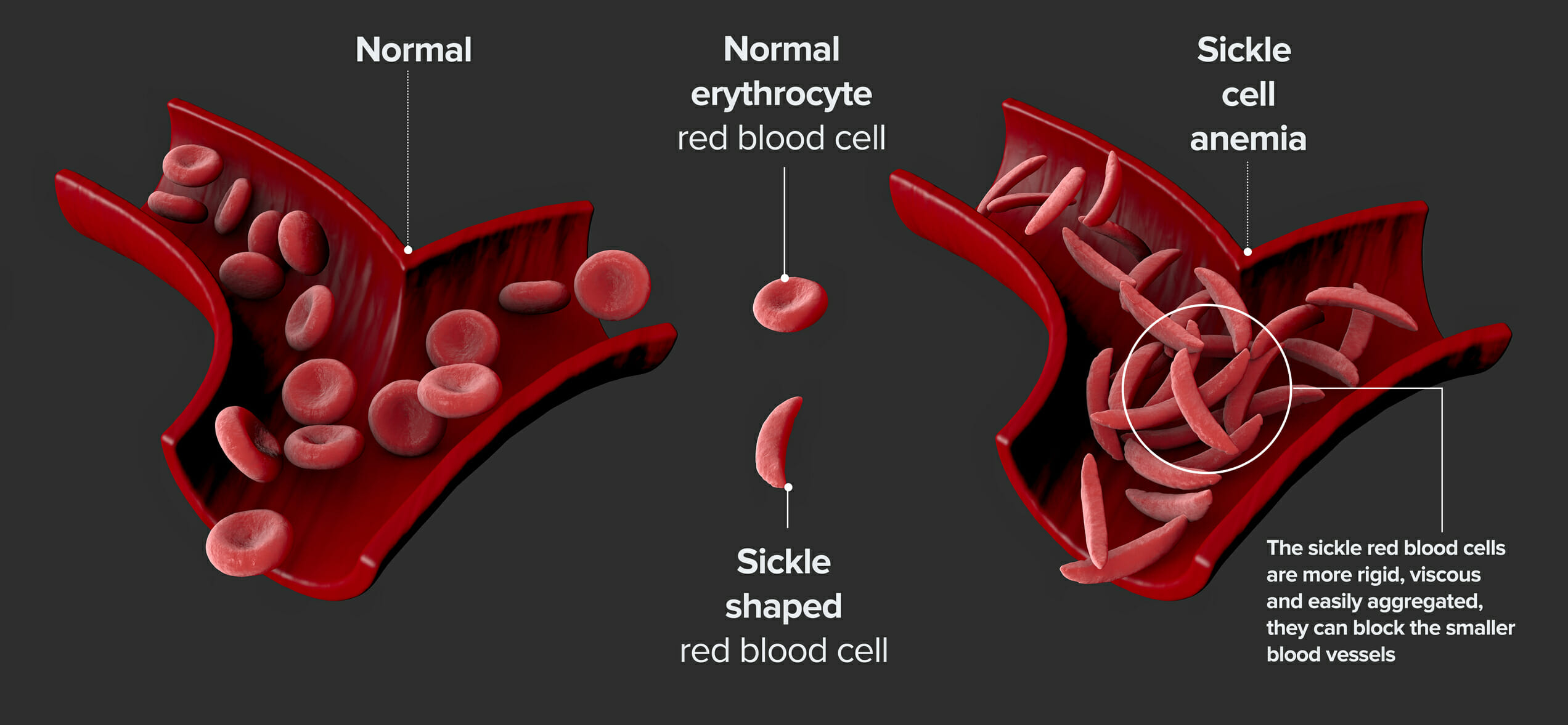 How Sickle Cell Disease is Diagnosed